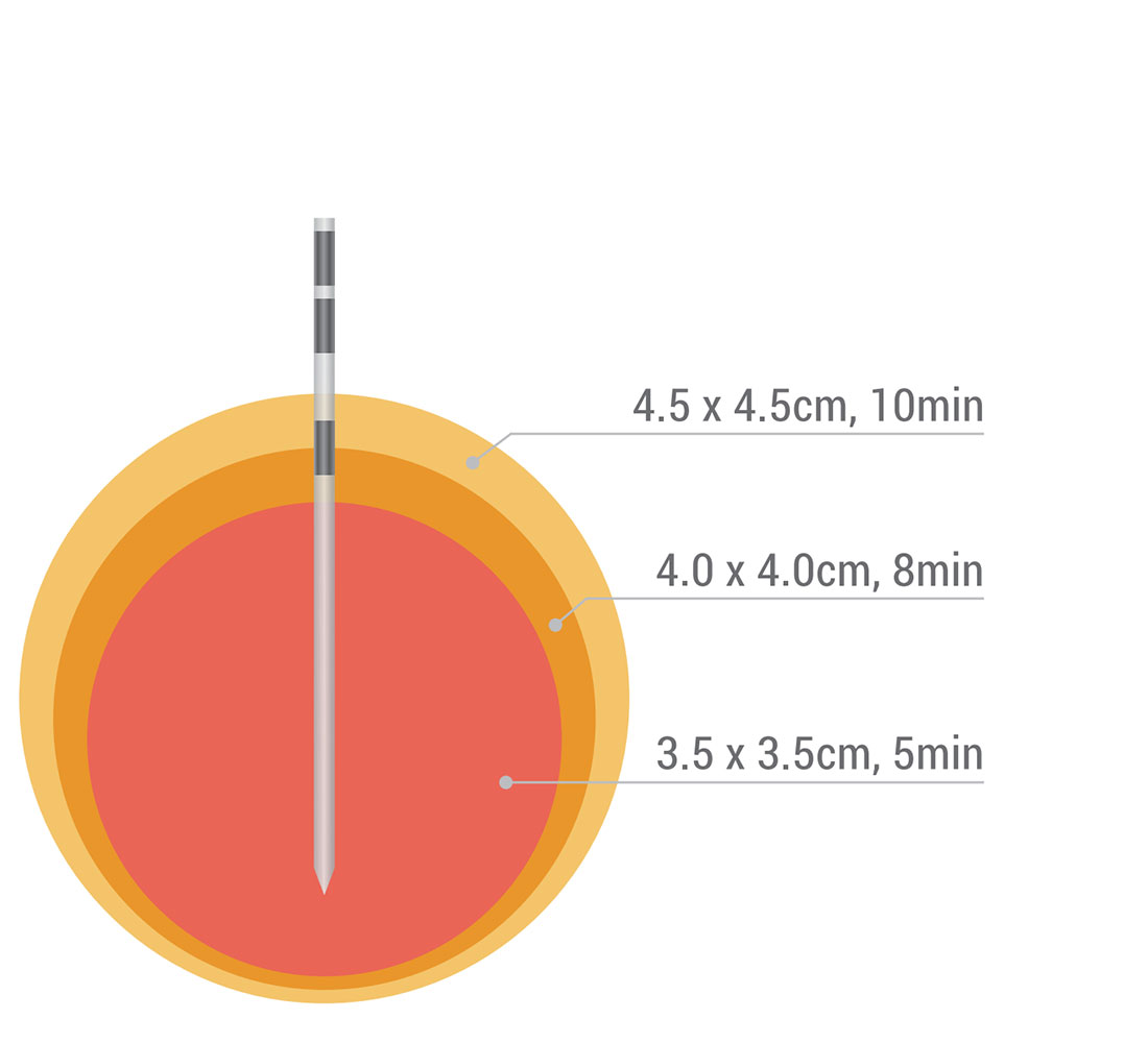 Dophi&trade;-M150E-Spherical-Ablation.3