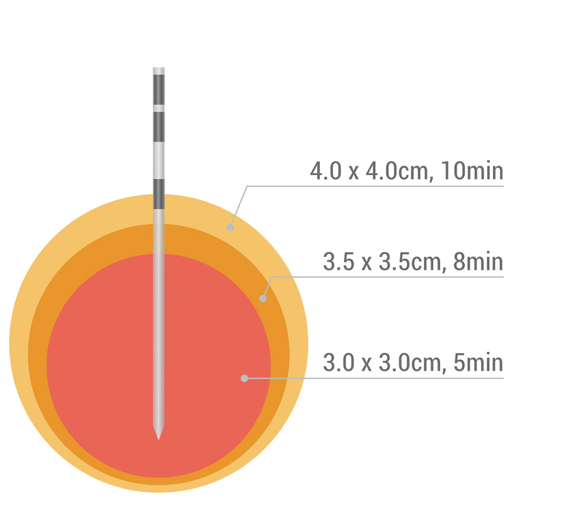 Dophi&trade;-M150E-Spherical-Ablation.2